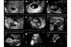 pregnancy trimesters